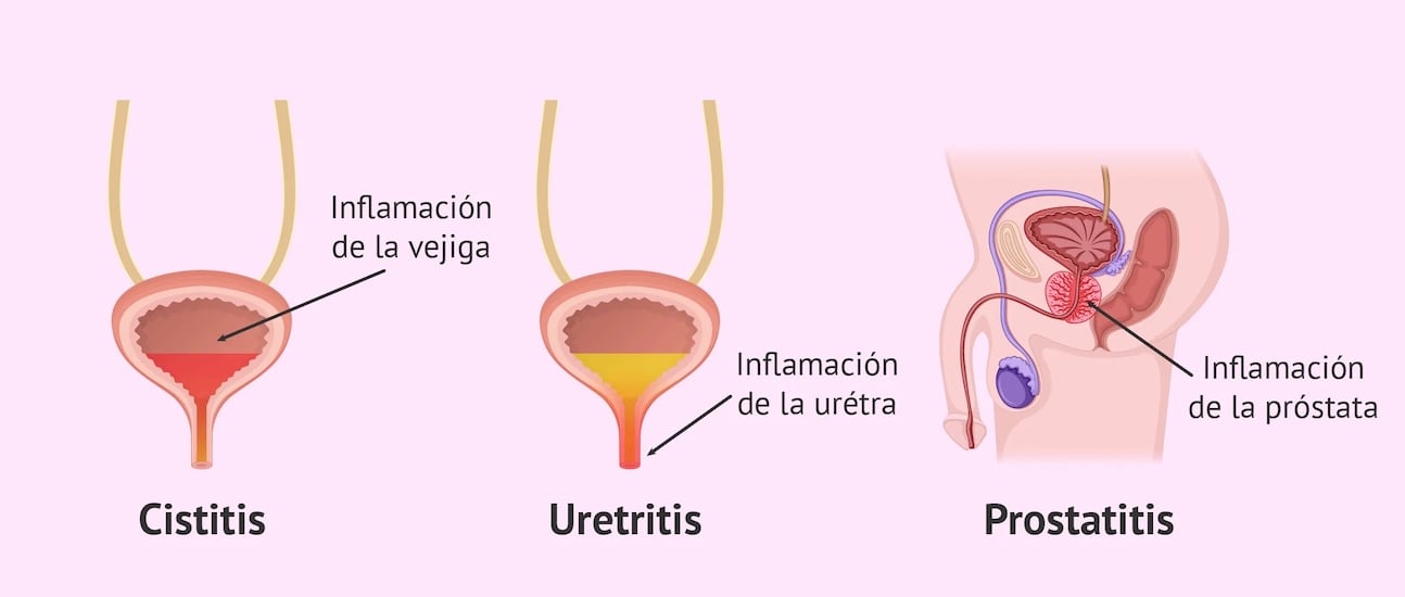 Uretritis atención médica en santiago