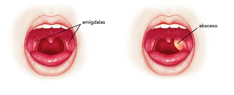 Absceso Periamigdalino cirugía de urgencia