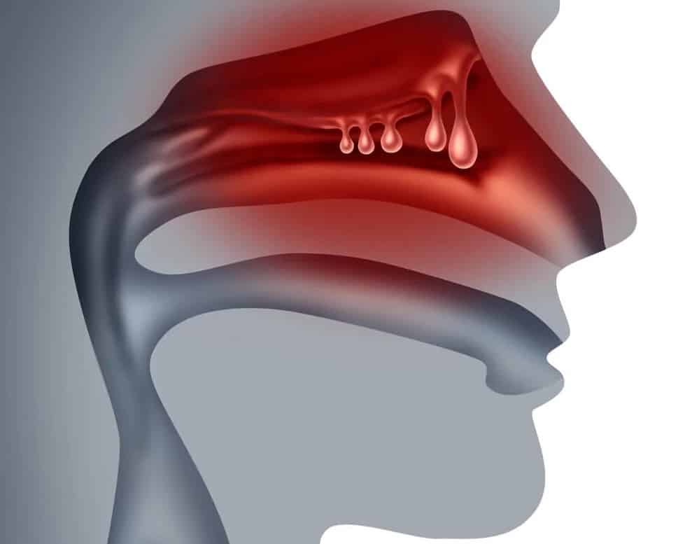 Biopsia de Mucosa Oronasofaríngea en santiago