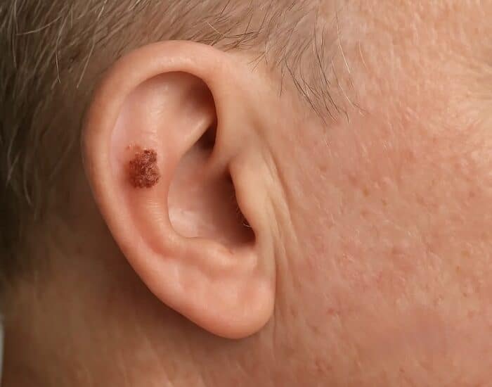Carcinoma Epidermoide dermatólogo oncólogo