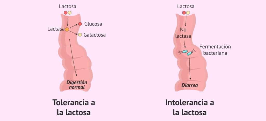 Intolerancia a la Lactosa exámenes en santiago
