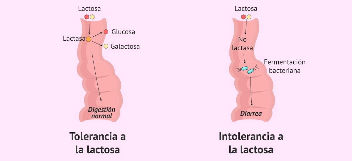 Intolerancia a la Lactosa exámenes en santiago