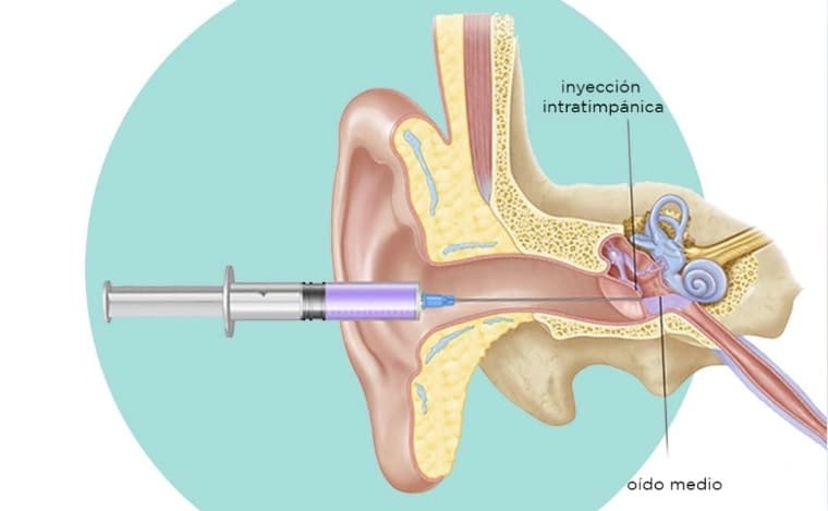 Inyección Intratimpánica de Corticoides de urgencia