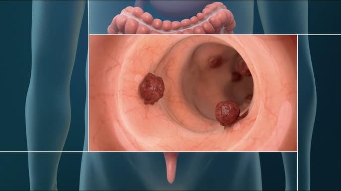 Tumor Rectal Velloso médico especialista en coloproctología