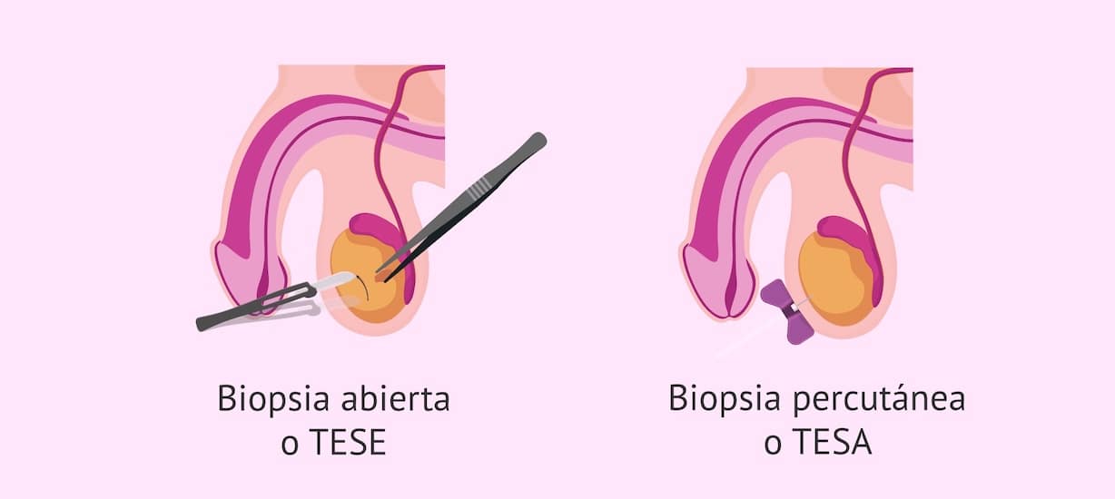 biopsia testicular en santiago