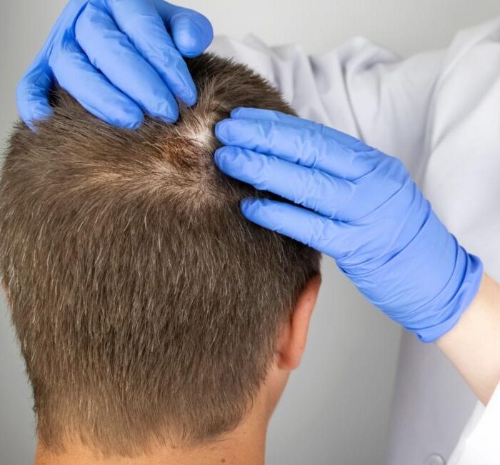 Alopecia Queloidea médico especialista en santiago