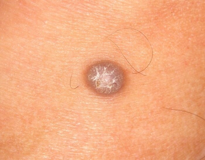 Dermatofibroma médico especialista en santiago