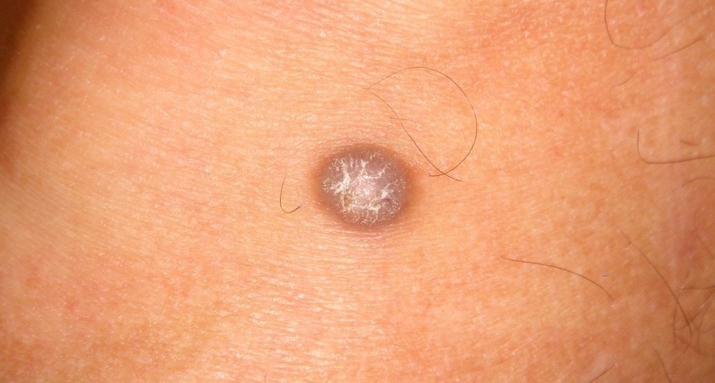 Dermatofibroma médico especialista en santiago