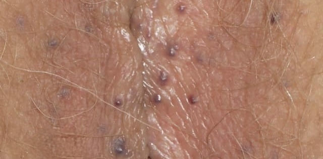 Angioqueratomas en Vulva extracción inmediata