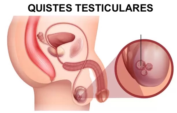 quistes testiculares con atención in mediata